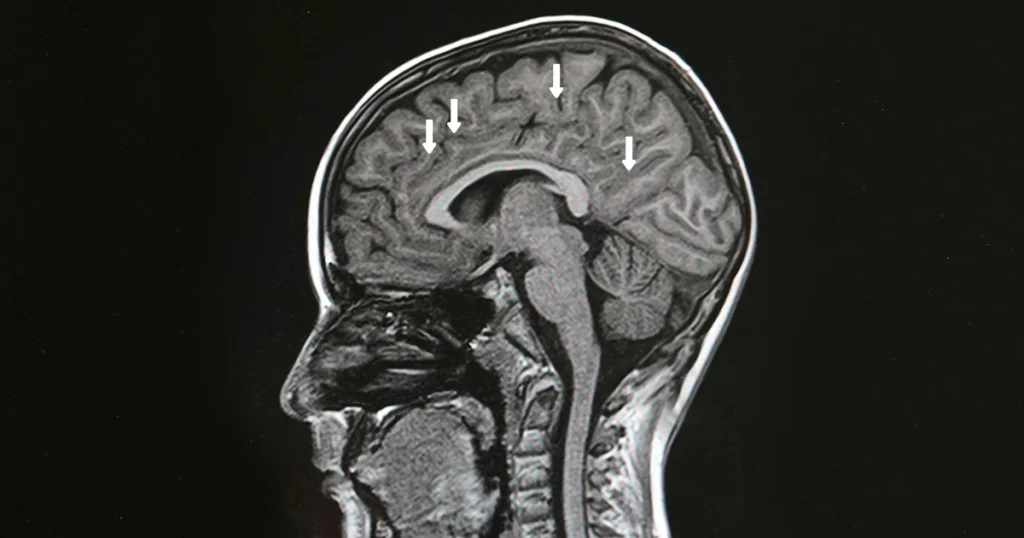 Brain MRI scan showing MS-related white matter lesions.
