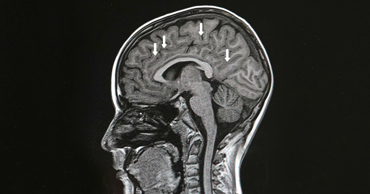 How Is Multiple Sclerosis Diagnosed? 