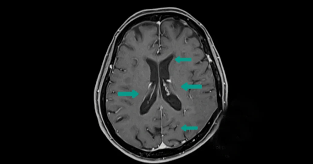 Brain MRI scan showing MS-related white matter lesions.