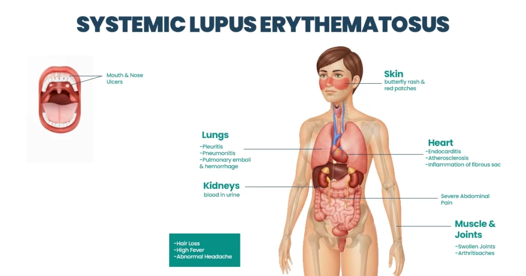 Lupus treatment overview with organs affected by systemic lupus.