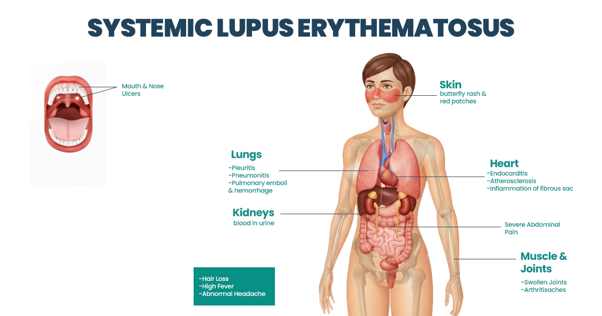 How to Treat Lupus