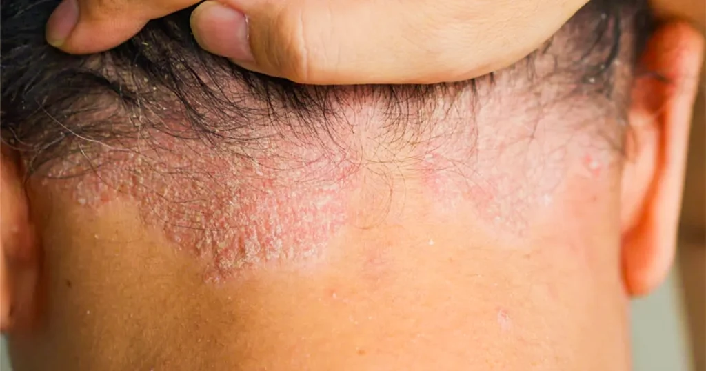 Psoriasis symptoms on scalp highlighting treatment needs