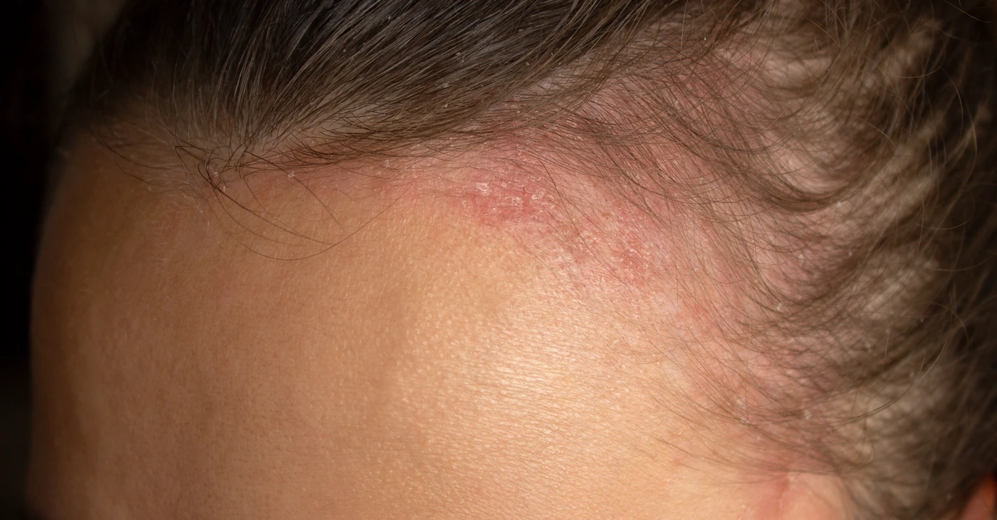 How to Treat Psoriasis