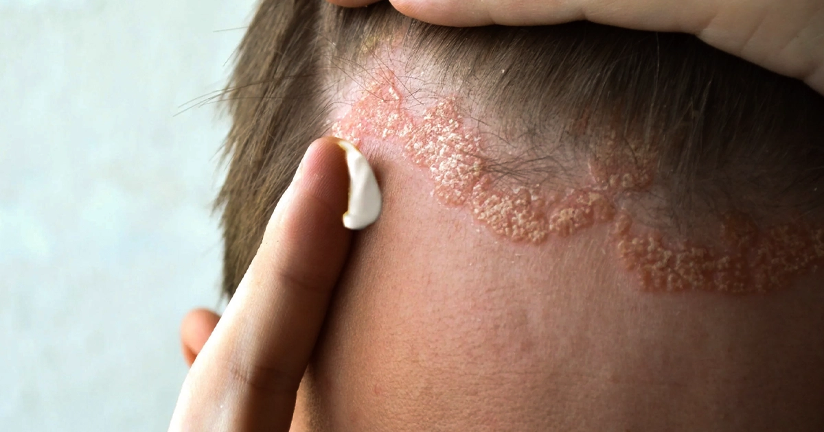 How to Treat Psoriasis on the Scalp