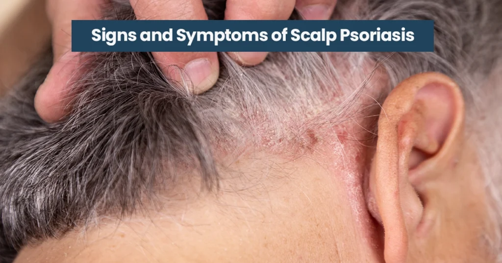 Scalp psoriasis with red, scaly patches near ear