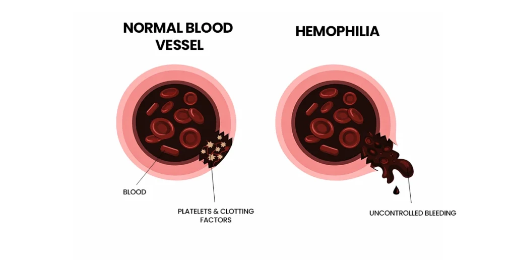 Comparison of normal blood vessels and hemophilia blood flow.