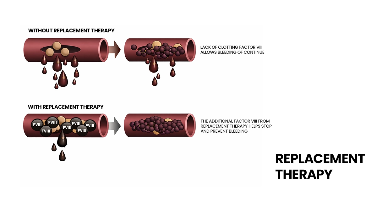 How Can Hemophilia Be Treated