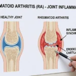 Diagram comparing a healthy joint with a rheumatoid arthritis–affected
