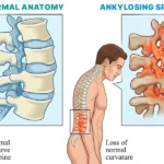 Comparison of healthy spine and ankylosing spondylitis showing curvature loss.