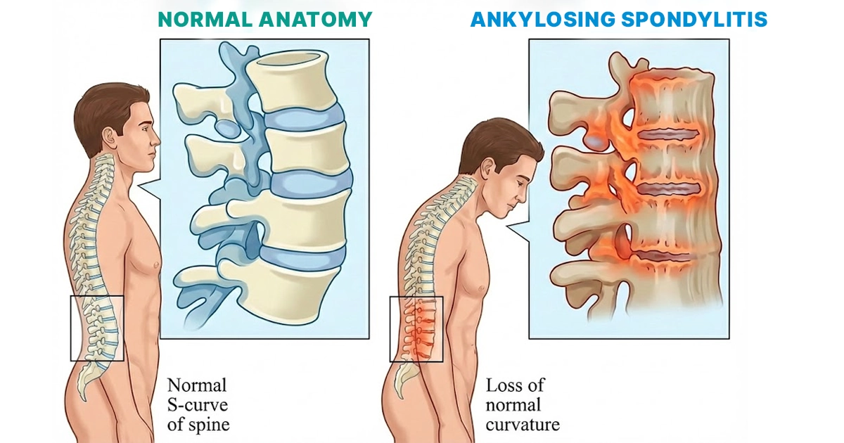 What is Ankylosing Spondylitis?