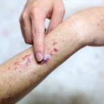 Close-up of a hand pointing to a purple skin rash and small blisters on a leg.