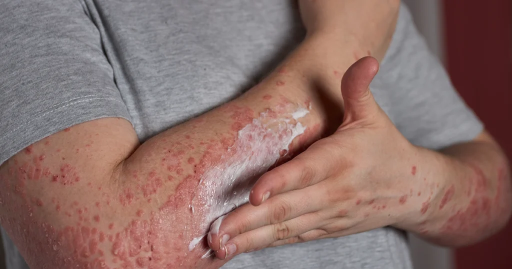Person applying cream to a red, irritated skin rash on the arms.