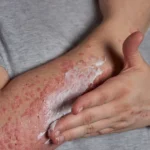 Person applying cream to a red, irritated skin rash on the arms.
