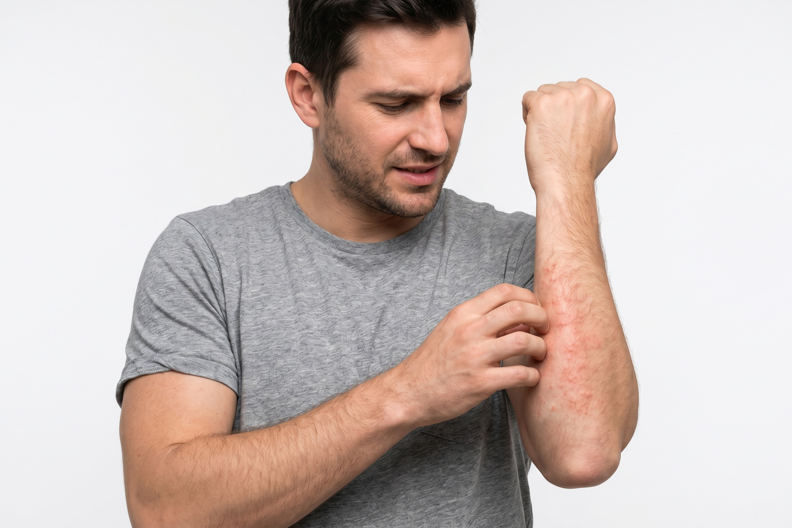 How To Treat Eczema