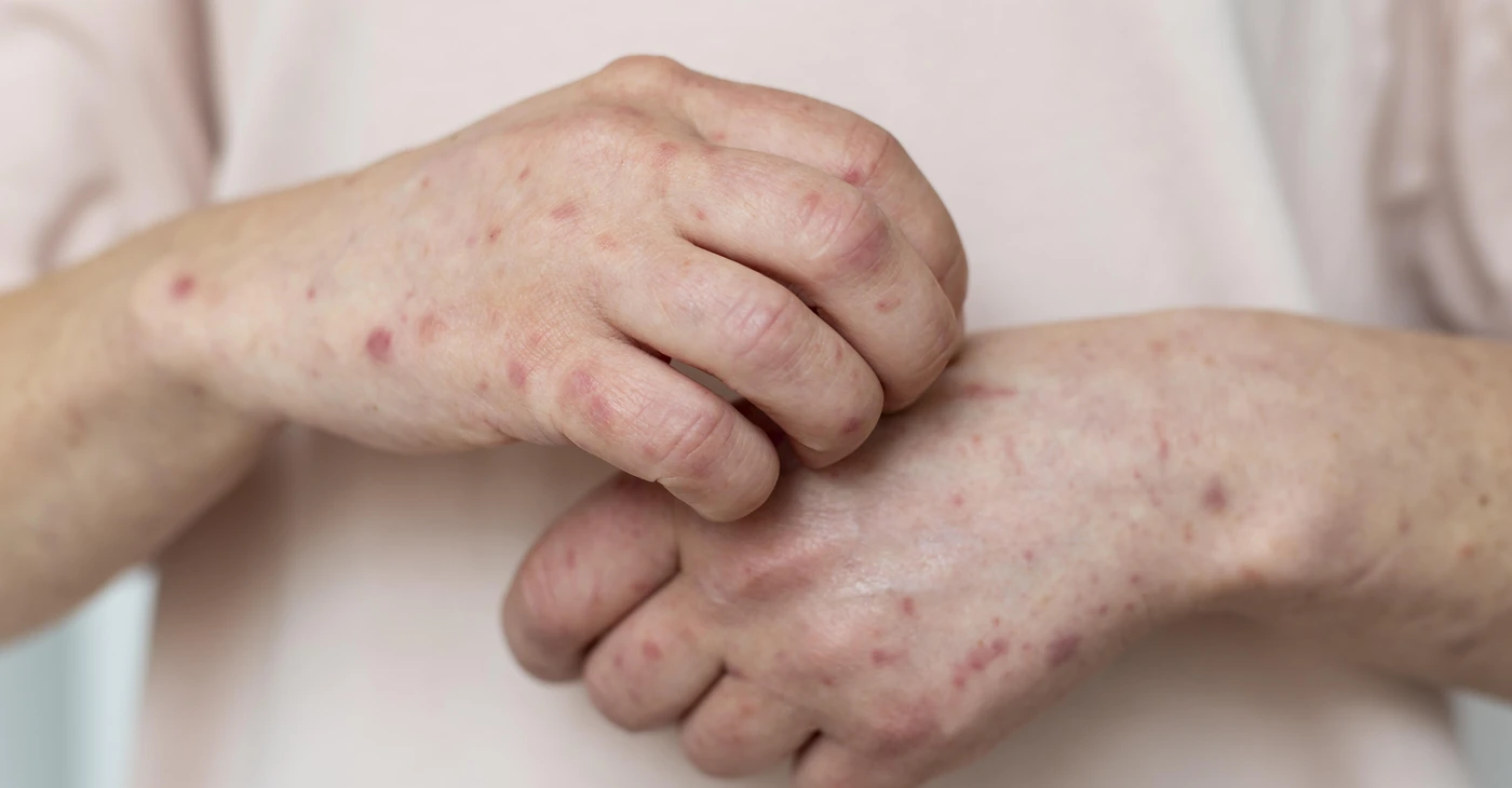 How To Treat Fabry Disease
