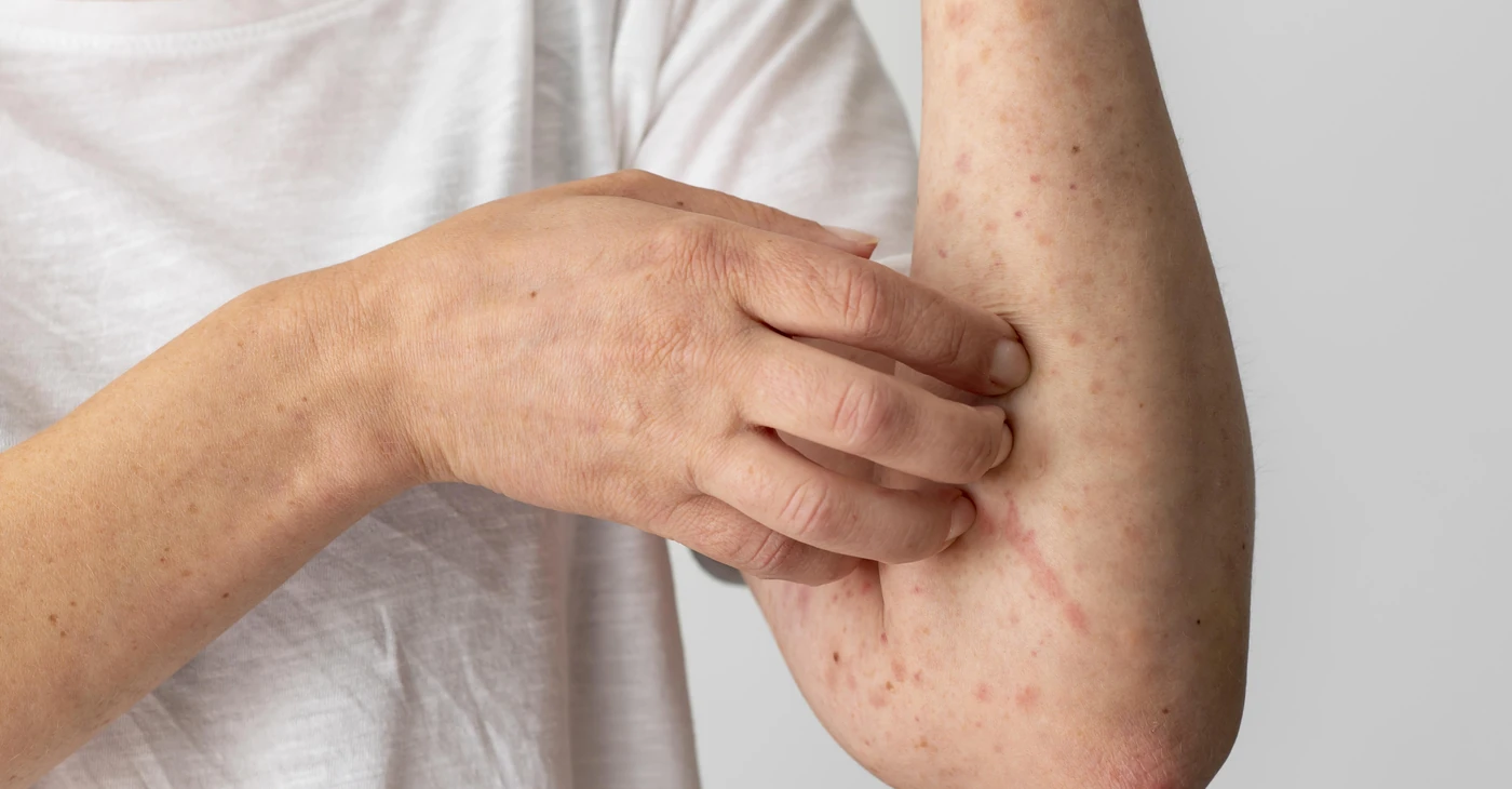 How To Treat Eczema