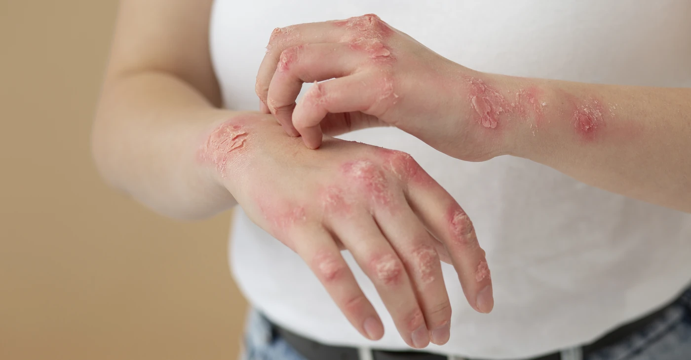 Dermatomyositis Treatment & Management