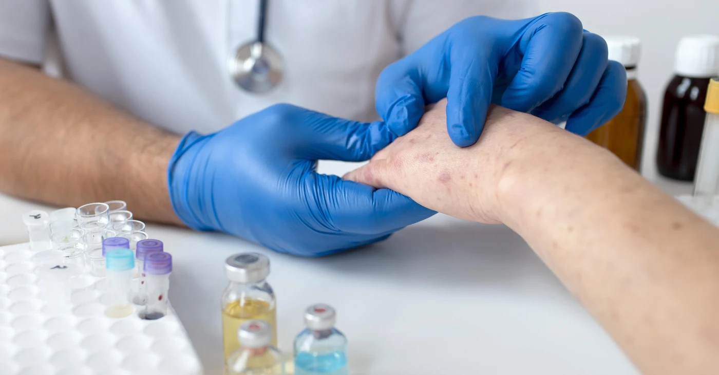 How to Treat Vasculitis